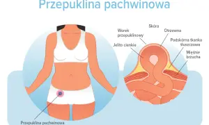 Ilustracja pokazuje przepuklinę pachwinową u kobiety. Dowiedz się, jak długo można chodzić z przepukliną pachwinową i jakie są jej objawy.