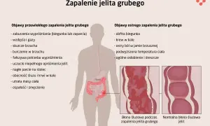 Ilustracja przedstawia objawy zapalenia jelita grubego, w tym problemy gastryczne jak biegunka, bóle brzucha i krew w kale.