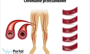 Chromanie przestankowe: Ćwiczenia, które cofną ból i przywrócą ruch