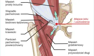 Anatomia pachwiny z zaznaczonym miejscem bólu i uszkodzenia, typowym dla pubalgii sportowej. Widoczne mięśnie brzucha, biodrowo-lędźwiowy i przywodziciele.
