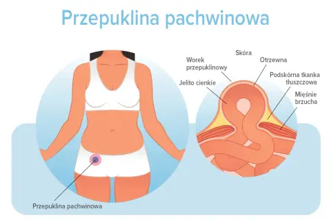 Ilustracja pokazuje przepuklinę pachwinową u kobiety. Dowiedz się, jak długo można chodzić z przepukliną pachwinową i jakie są jej objawy.