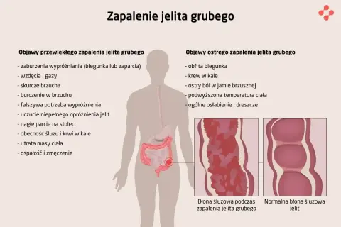 Ilustracja przedstawia objawy zapalenia jelita grubego, w tym problemy gastryczne jak biegunka, bóle brzucha i krew w kale.