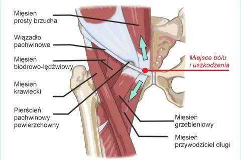 Anatomia pachwiny z zaznaczonym miejscem bólu i uszkodzenia, typowym dla pubalgii sportowej. Widoczne mięśnie brzucha, biodrowo-lędźwiowy i przywodziciele.