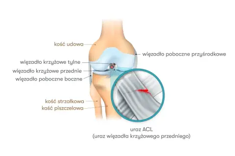 Anatomia kolana z zaznaczonym urazem ACL (przedniego więzadła krzyżowego). Widoczne kości i więzadła.