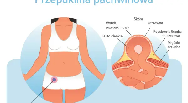 Ilustracja pokazuje przepuklinę pachwinową u kobiety. Dowiedz się, jak długo można chodzić z przepukliną pachwinową i jakie są jej objawy.