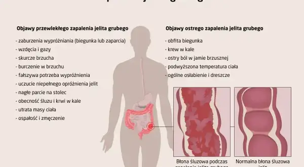Ilustracja przedstawia objawy zapalenia jelita grubego, w tym problemy gastryczne jak biegunka, bóle brzucha i krew w kale.