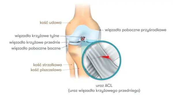 Anatomia kolana z zaznaczonym urazem ACL (przedniego więzadła krzyżowego). Widoczne kości i więzadła.