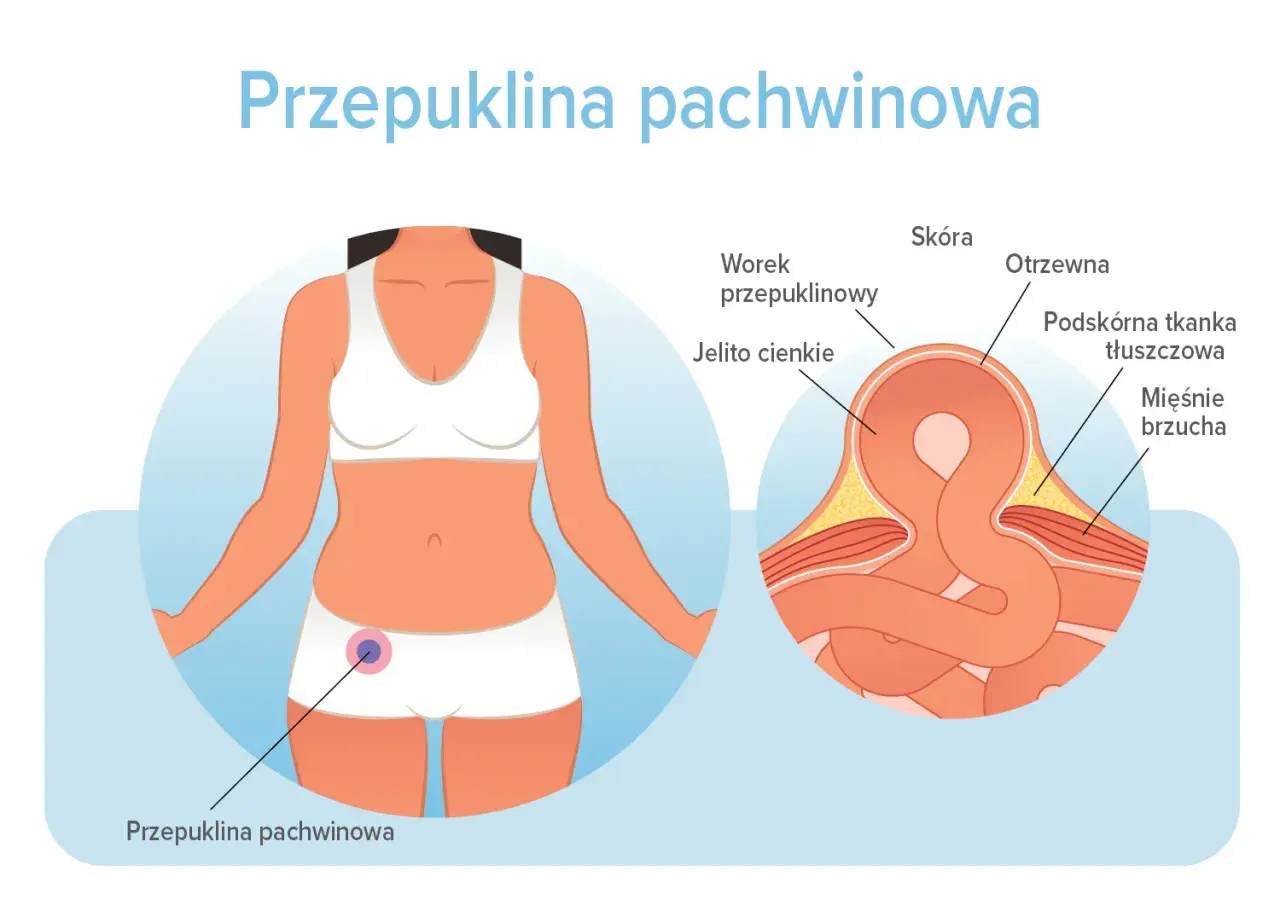 Ilustracja pokazuje przepuklinę pachwinową u kobiety. Dowiedz się, jak długo można chodzić z przepukliną pachwinową i jakie są jej objawy.