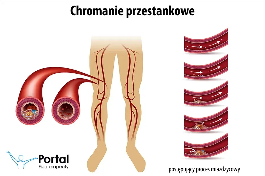 Chromanie przestankowe: Ćwiczenia, które cofną ból i przywrócą ruch