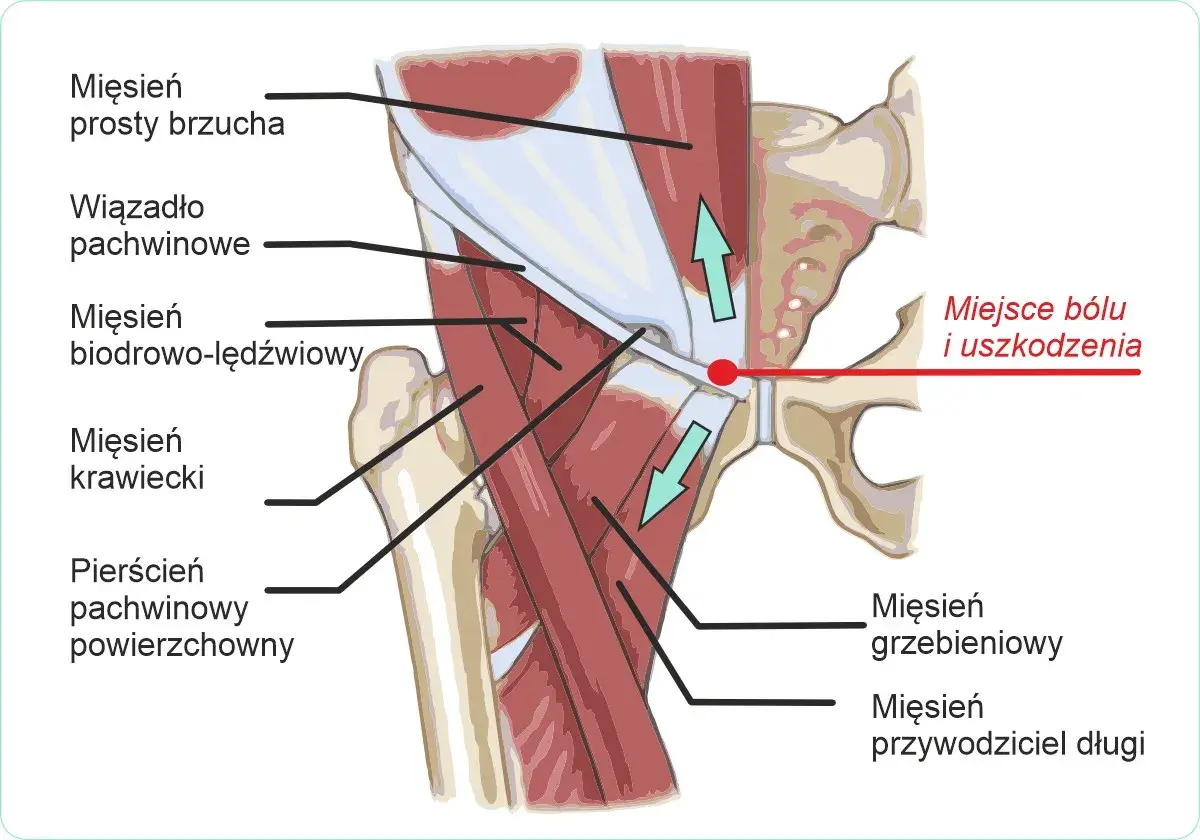 Anatomia pachwiny z zaznaczonym miejscem bólu i uszkodzenia, typowym dla pubalgii sportowej. Widoczne mięśnie brzucha, biodrowo-lędźwiowy i przywodziciele.