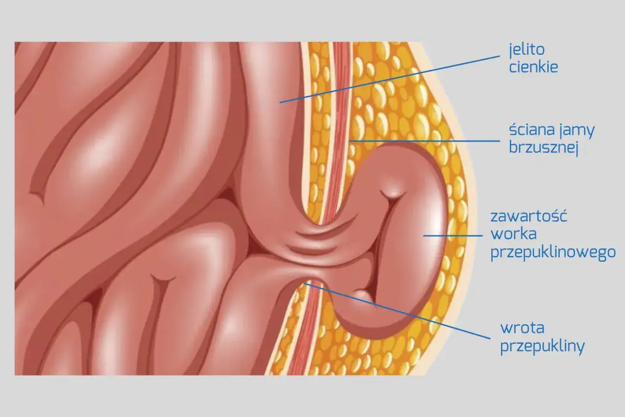 Ilustracja pokazuje przepuklinę pachwinową: jelito cienkie przechodzi przez ścianę jamy brzusznej. Nie należy zwlekać z leczeniem, jak długo można chodzić z przepukliną pachwinową, zależy od wielu czynników.