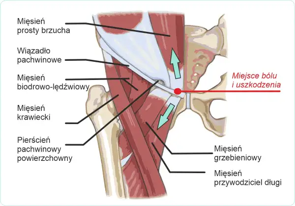 Anatomia pachwiny z zaznaczonym miejscem bólu i uszkodzenia, typowym dla pubalgii sportowej. Widoczne mięśnie brzucha, biodrowo-lędźwiowy i przywodziciele.