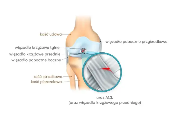 Anatomia kolana z zaznaczonym urazem ACL (przedniego więzadła krzyżowego). Widoczne kości i więzadła.