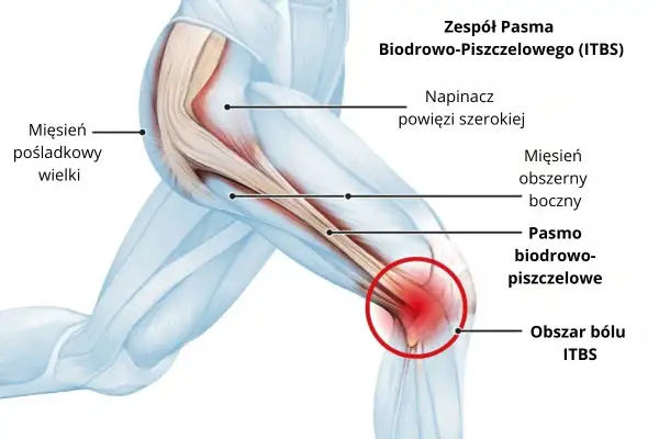 Anatomia kolana z zaznaczonym pasmem biodrowo-piszczelowym, obszarem bólu ITBS i mięśniami.